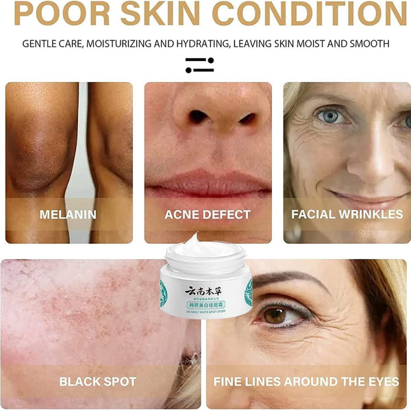 Japanese Melasma & Dark Spot Removal Cream – Dr. Hancy & Hoshi Whitening Herbal Formula (Yunnan Freckle Treatment) – alternate view