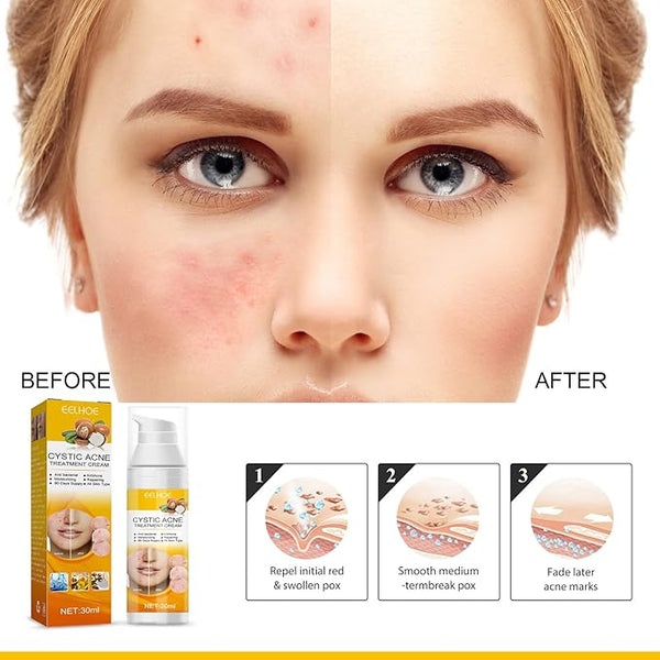 EELHOE Cystic Acne Treatment Cream – Anti-Acne, Hydrating & Moisturizing Formula for Clear, Smooth Skin (30ml) – alternate view