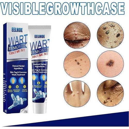 EELHOE Wart Remover Cream – Natural Wart, Corn & Skin Tag Removal Ointment for Clear, Healthy Skin (20g)