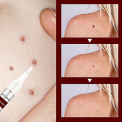 Jaysuing Liquid Wart Flat – Advanced Wart Remover for Face, Hands & Body (20ml)