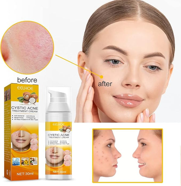 EELHOE Cystic Acne Treatment Cream – Anti-Acne, Hydrating & Moisturizing Formula for Clear, Smooth Skin (30ml)